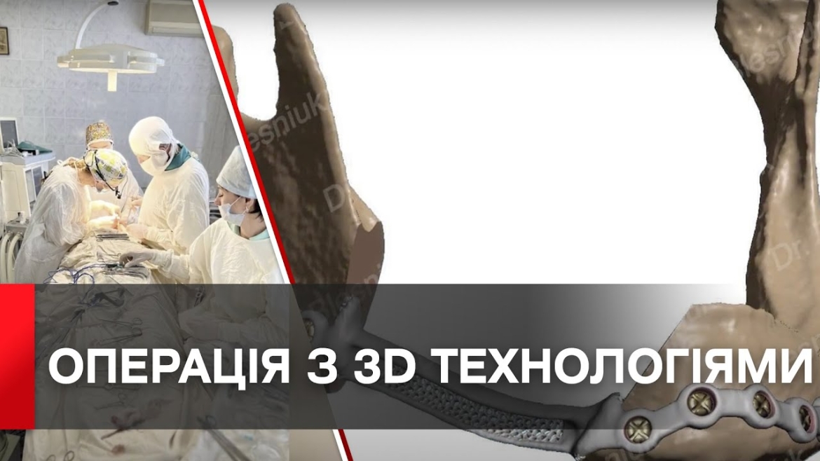 Embedded thumbnail for Титановий імплант замість частини щелепи: в онкоцентрі проводять операції з 3D технологіями