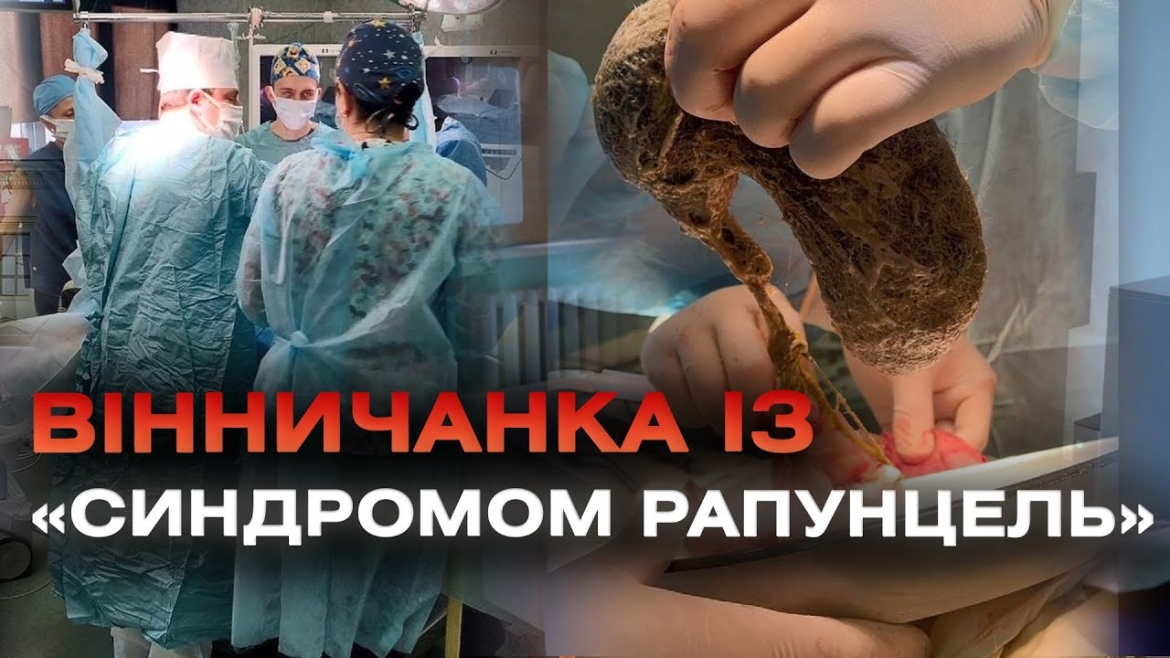 Embedded thumbnail for Зі шлунку 11-річної вінничанки дістали величезний жмут її власного волосся